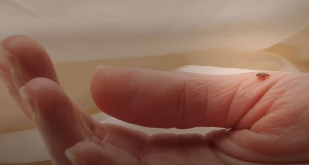 פשפש המיטה על יד אנושית